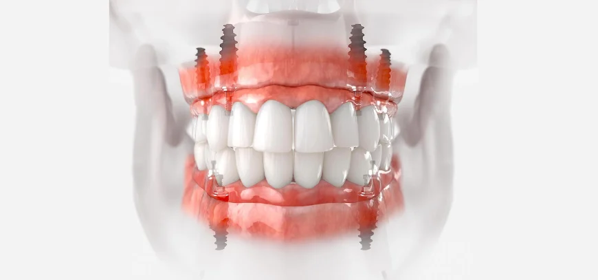 dental implant by dr ashish jain